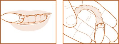 Cuidado-diario-y-mantenimiento-de-los-alineadores-Invisalign